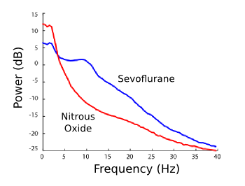 Brainwave spectra under an ether and nitrous oxide anesthetic.
