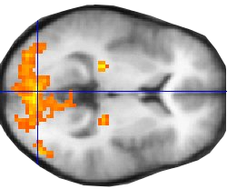 Functional magnetic resonance image