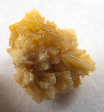 A kidney stone